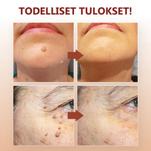 Eteesi läiskien ja luomen poistoon - Osta 1 saat 1 ilmaiseksi (2 kpl)
