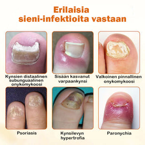 Edistynyt kynsien korjaussuihke